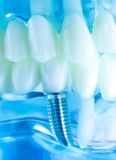 Dental implants Brisbane
