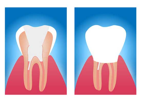 Root Canal Treatment in Rochedale