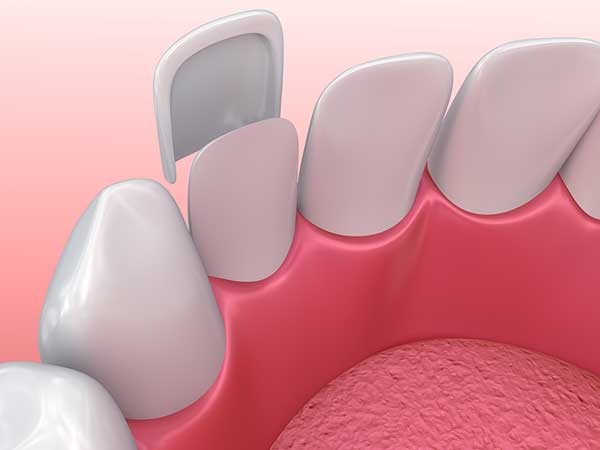 Dental veneers